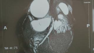 Quá trình đặt 4 stent điều trị nhồi máu cơ tim của bác Nguyễn Văn Niêm 75 tuổi